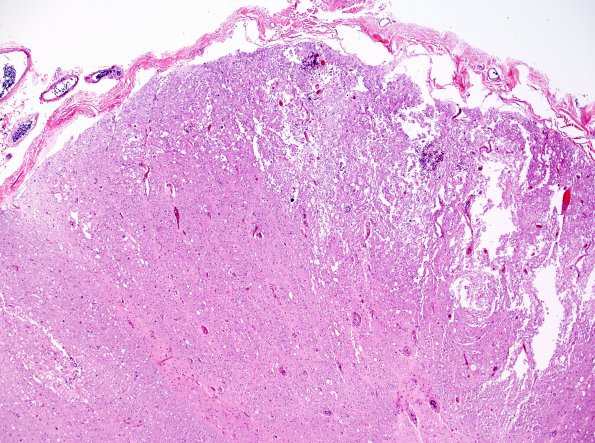 8E2 Lymphoma, Large B-cell IV (Case 8) N10 H&E 5