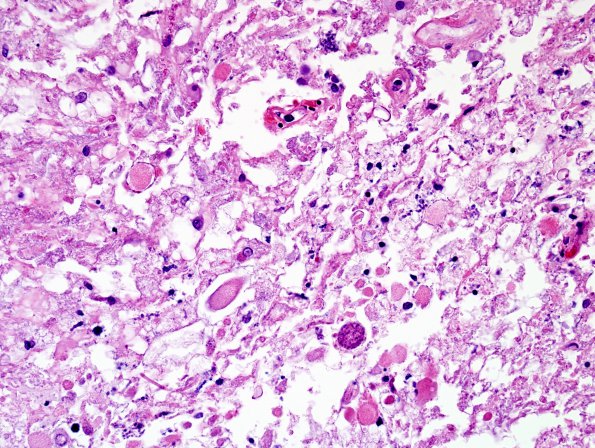 8E3 Lymphoma, Large B-cell IV (Case 8) N10 H&E 1