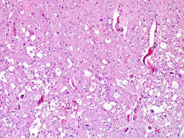 8E4 Lymphoma, Large B-cell IV (Case 8) N10 H&E 4