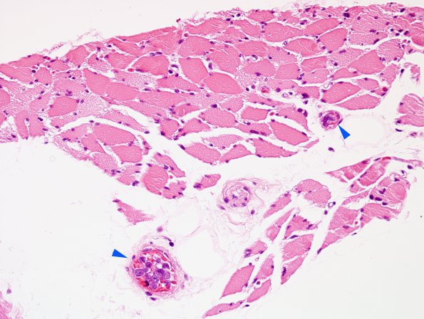 8F1 Lymphoma, Large B-cell IV (Case 8) H&E 1 copy