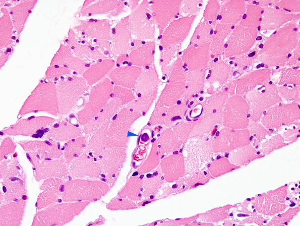 8F2 Lymphoma, Large B-cell IV (Case 8) H&E 3 copy