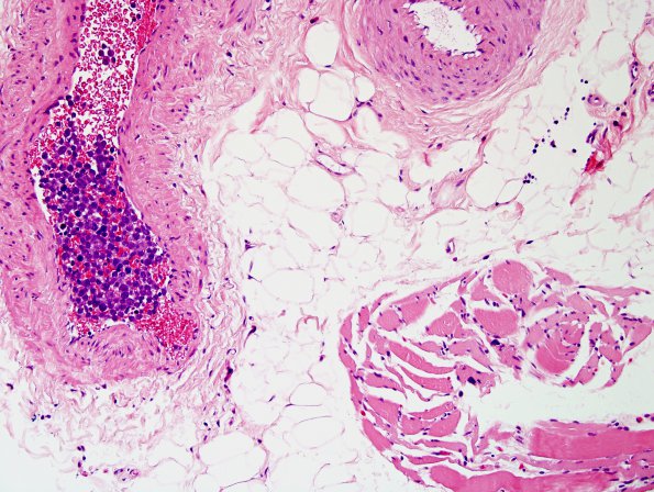 8F3 Lymphoma, Large B-cell IV (Case 8) H&E 4