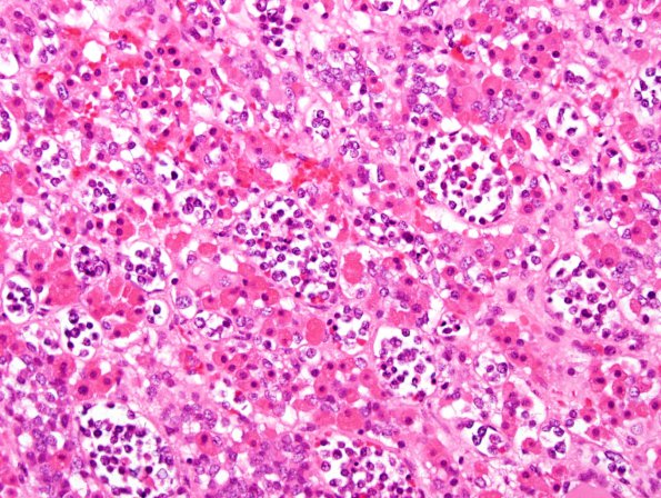 8G Lymphoma, intravascular, pituitary (Case 8)-H&E-40x-4