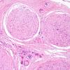 9A1 Lymphoma, iv (Case 9) H&E 20X.