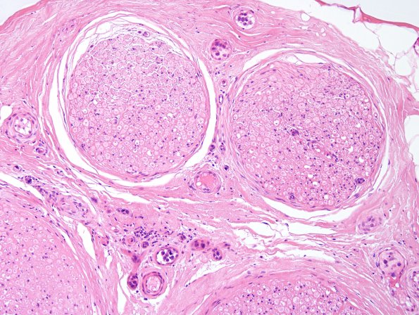 9A1 Lymphoma, iv (Case 9) H&E 20X.