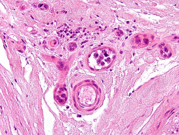 9A2 Lymphoma, iv (Case 9) H&E 2