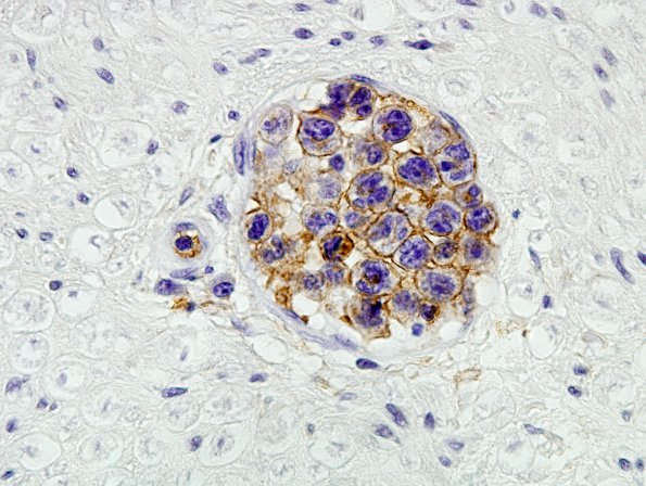 9B2 Lymphoma, iv (Case 9) LCA 4