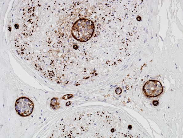 9D Lymphoma, iv (Case 9) Ulex 7