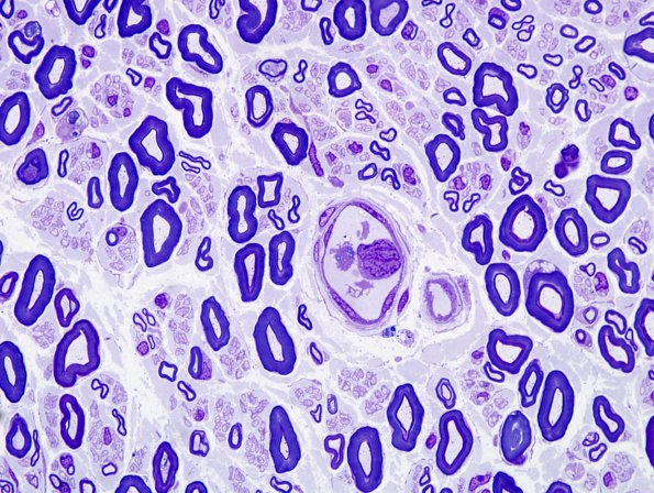 9E Lymphoma, iv (Case 9) Plastic 4