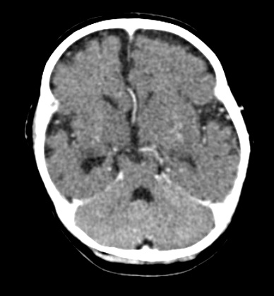 1A1 Lymphoma, B-cell (PTLD, Case 1) CT no Contrast - Copy