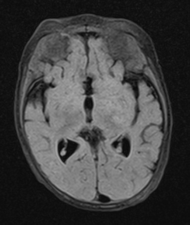 1A2 Lymphoma, B-cell (PTLD, Case 1) FLAIR 1 - Copy