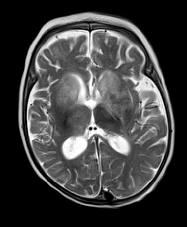 1A3 Lymphoma, PTLD (Case 1) T2 - Copy