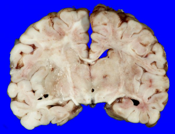 1B2 Lymphoma, B-cell (PTLD, Case 1) 2