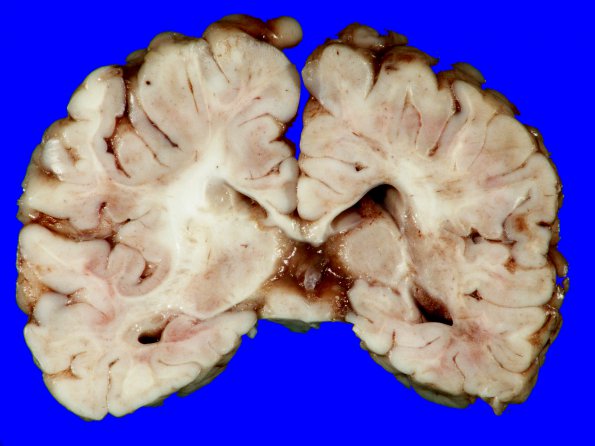 1B3 Lymphoma, B-cell(PTLD, Case 1) 3