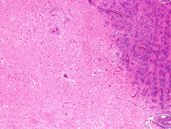 1C2 Lymphoma, B-cell (PTLD, Case 1) H&E 9