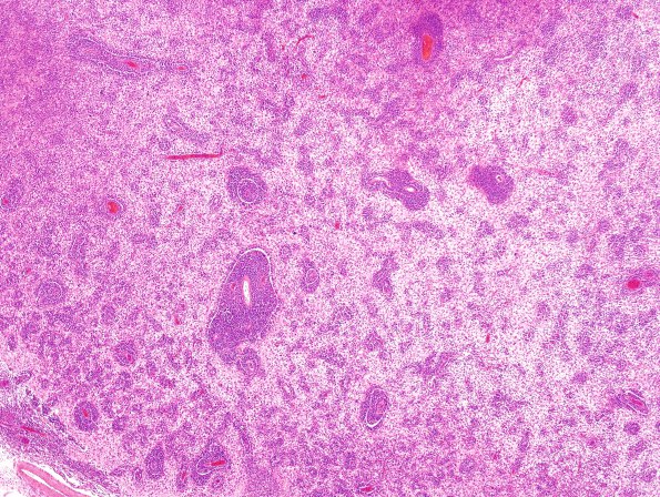 1C3 Lymphoma, B-cell (PTLD, Case 1) H&E 10