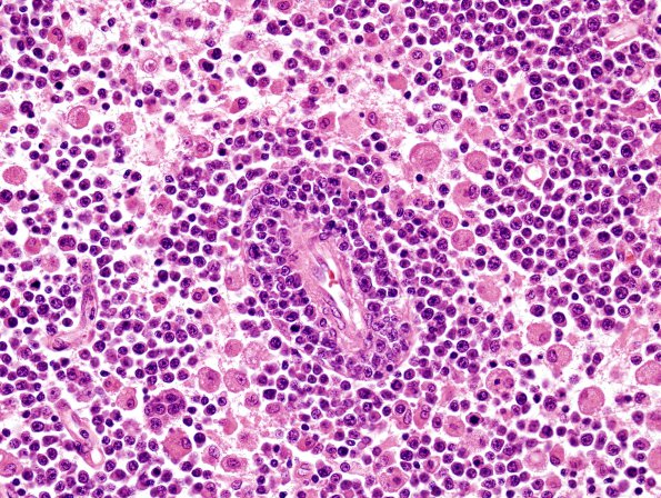 1C4 Lymphoma, B-cell (PTLD, Case 1) H&E 6