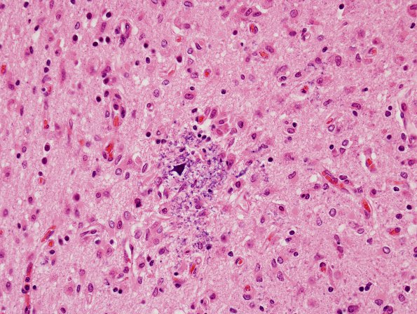1D2 Lymphoma, B-cell (PTLD, Case 1) H&E 4
