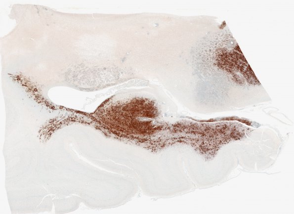 1E1 Lymphoma, B-cell (PTLD, Case 1) N3 CD20