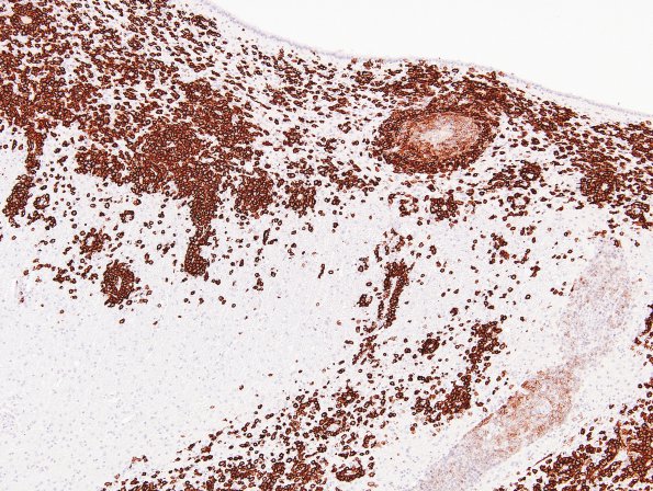1E2 Lymphoma, B-cell (PTLD, Case 1) N3 CD20 1
