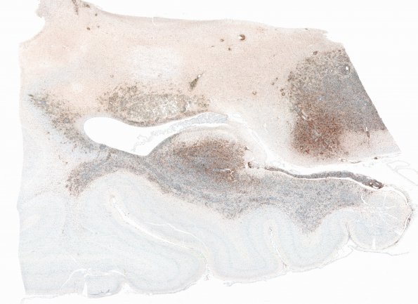 1F1 Lymphoma, B-cell (PTLD, Case 1) N3 CD3