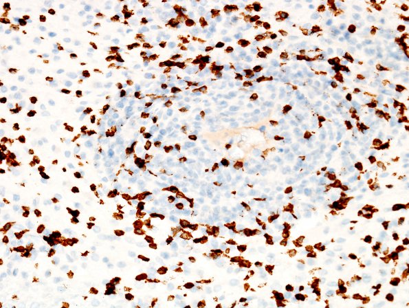 1F3 Lymphoma, B-cell (PTLD, Case 1) N3 CD3 1