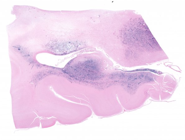 1G1 Lymphoma, B-cell (PTLD, Case 1) EBV ISH 3