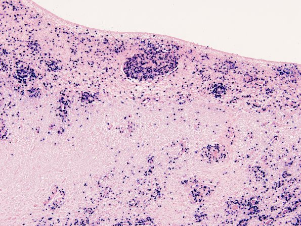 1G2 Lymphoma, B-cell (PTLD, Case 1) N3 EBV 1