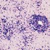 1G3 Lymphoma, B-cell (PTLD, Case 1) EBV ISH