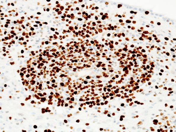 1H3 Lymphoma, B-cell (PTLD, Case 1) N3 MIB 2