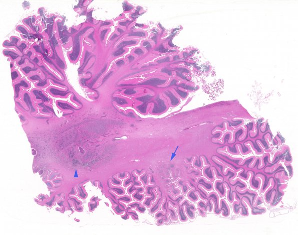 1I1 Lymphoma, B-cell (PTLD, Case 1) N15 H&E copy