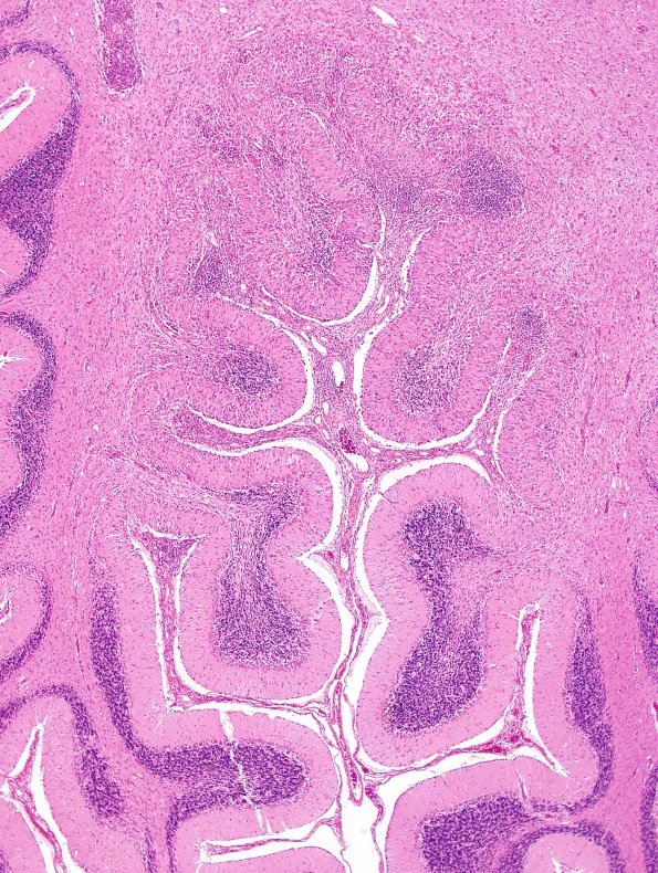 1I2 Lymphoma, B-cell (PTLD, Case 1) N15 H&E 3