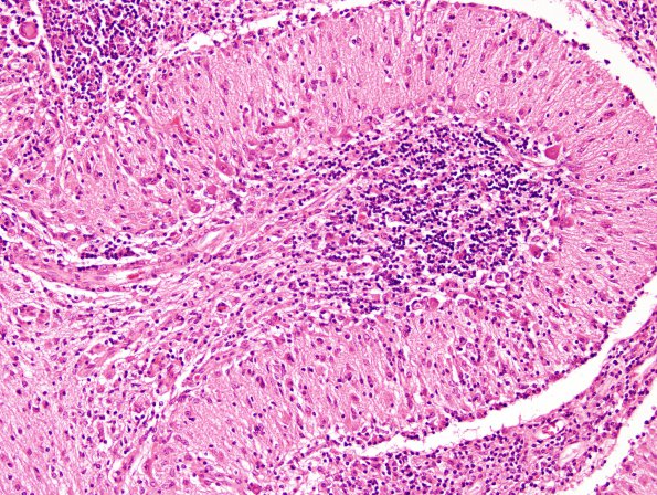 1I3 Lymphoma, B-cell (PTLD, Case 1) N15 H&E 1