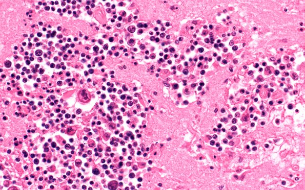 10B2 Lymphoma, HIV (Case 10) H&E 1