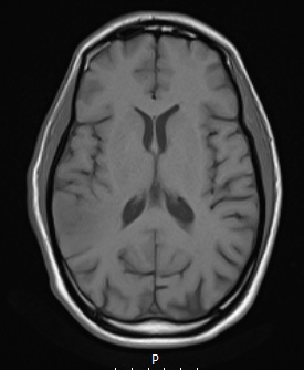 12A1 DLBCL (Case 12) T1 NC - Copy