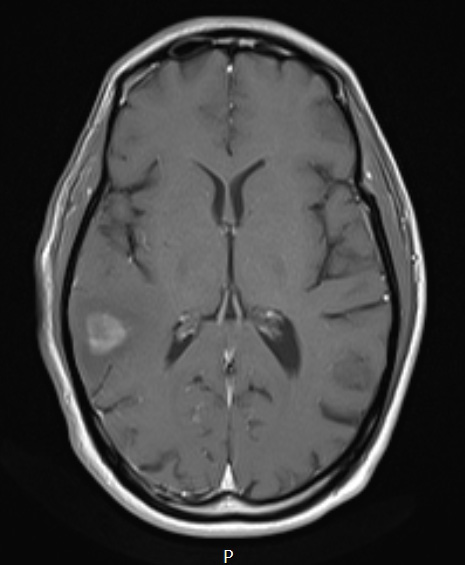 12A2 DLBCL (Case 12)  T1W - Copy