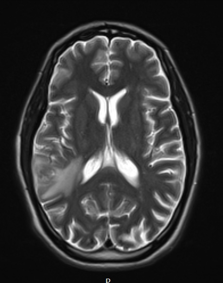 12A3 DLBCL (Case 12) T2 - Copy