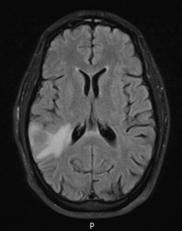 12A4 DLBCL (Case 12) T2 dark fluid - Copy