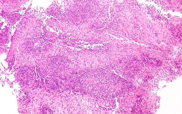 12B1 DLBCL EBER (Case 12) H&E 3