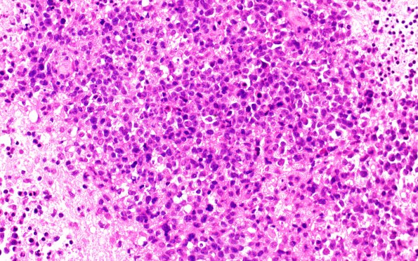 12B2 Lymphoma, EBER positive, diffuse B cell (Case 12) H&E 1