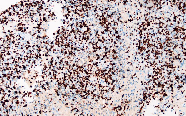 12E Lymphoma, EBER positive, diffuse B cell (Case 12) Ki67