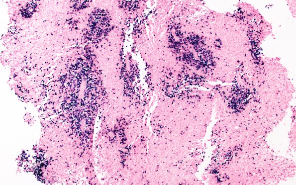 12F Lymphoma, EBER positive, diffuse B cell (Case 12) EBER 1