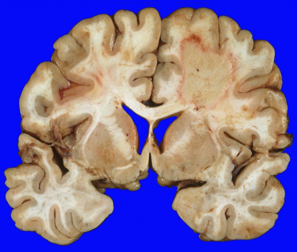 13A1 Lymphoma in AIDS EBV (Case 13) 3