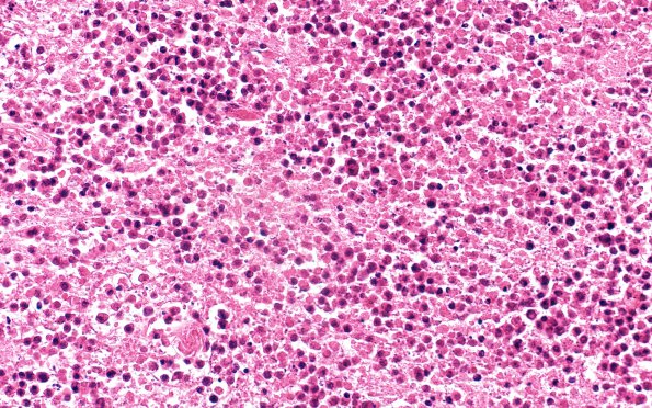 13B2 Lymphoma in AIDS EBV (Case 13) H&E 20X