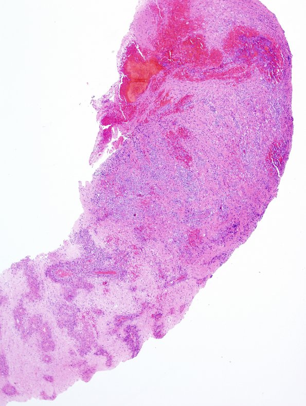 14C1 Lymphoma, 6 mo imm-supp (Case 14) 1 H&E.jpg
