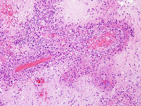14C2 Lymphoma, 6 mo imm-supp (Case 14) H&E 6.jpg