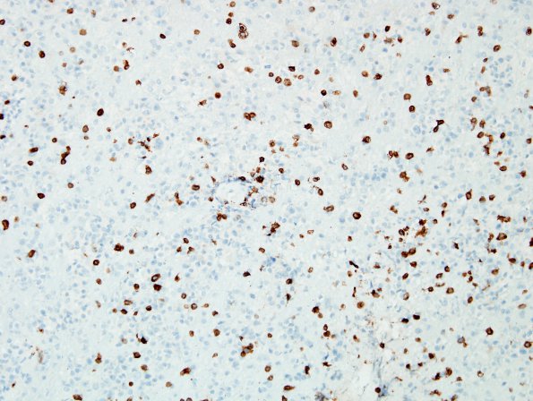 14D4 Lymphoma, 6 mo imm-supp (Case 14) CD3 4.jpg