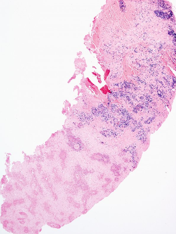 14E1 Lymphoma, 6 mo imm-supp (Case 14) EBER 4X.jpg