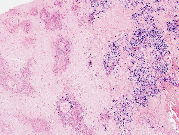 14E2 Lymphoma, 6 mo imm-supp (Case 14) EBER 4.jpg