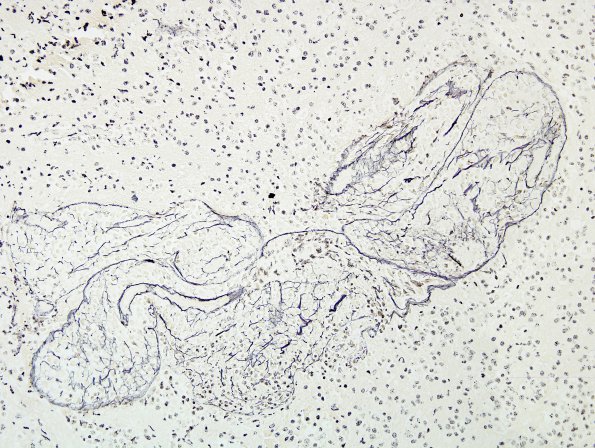 14F Lymphoma, 6 mo imm-supp (Case 14) Retic.jpg